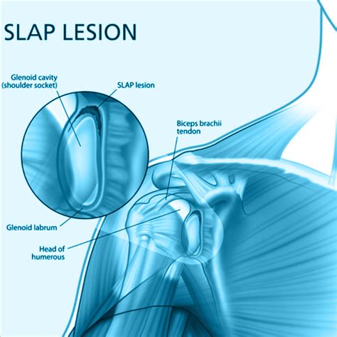 Superior Labrum Anterior Posterior (SLAP) Lesions